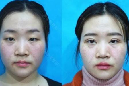 割双眼皮忌讳什么风水